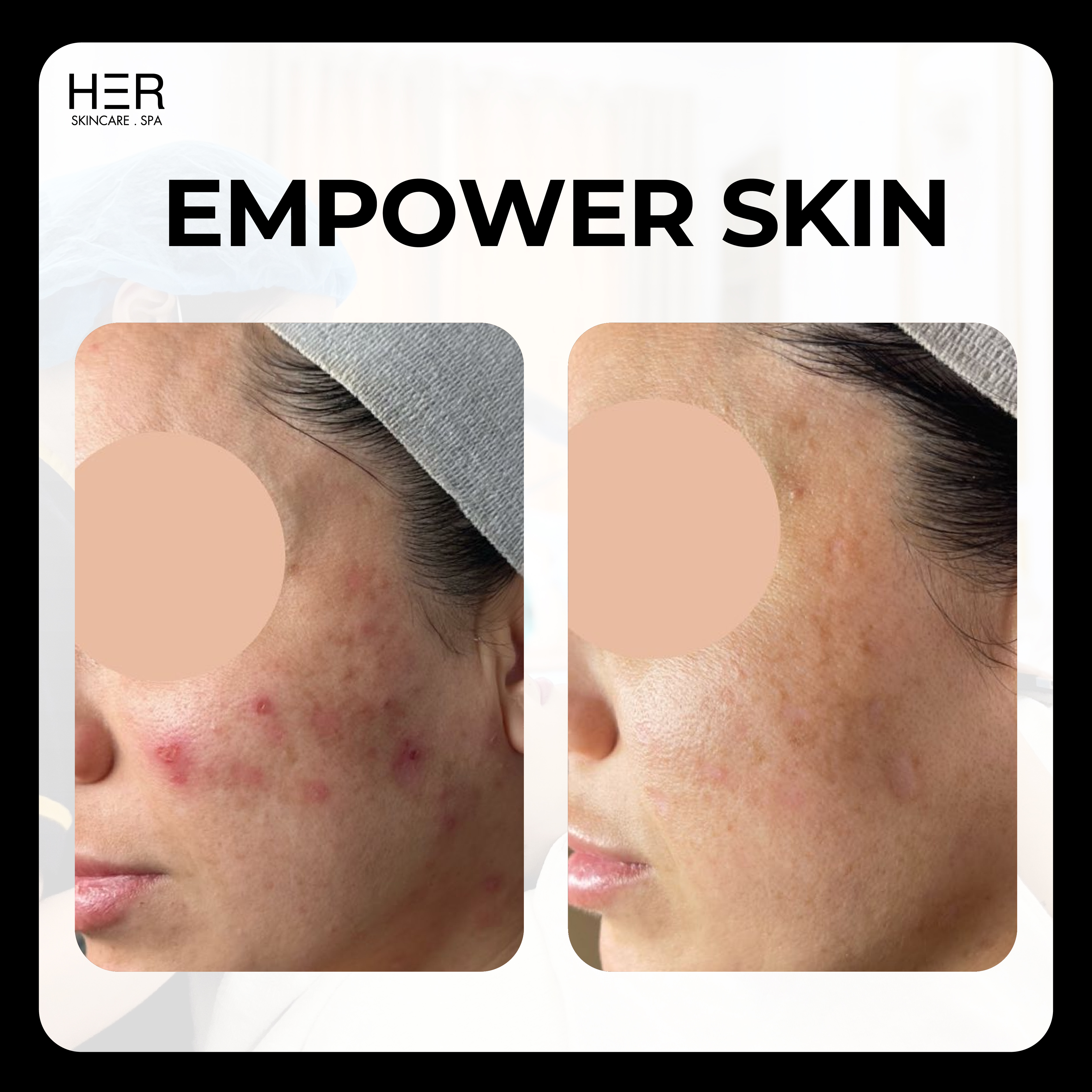 Empower Skin - Trị liệu cho da mẫn cảm & trẻ hoá da